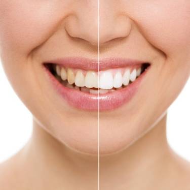 Blanqueamiento dental, comparación entre el antes y el después
