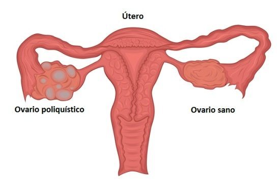 Síndrome del ovario poliquístico o SOP