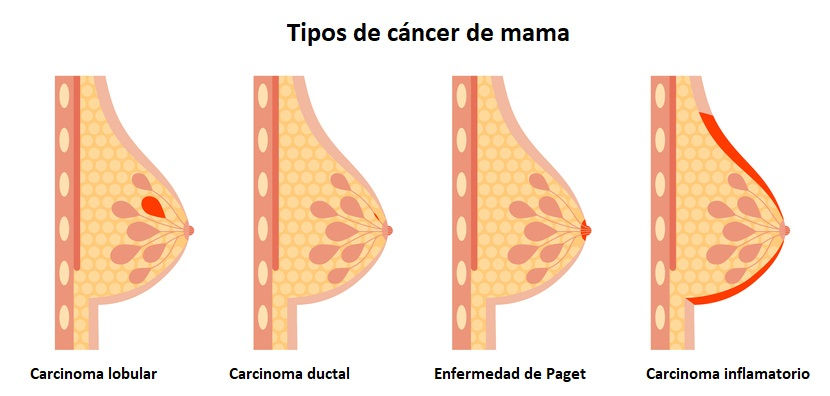 Infografía con los tipos de cáncer de mama