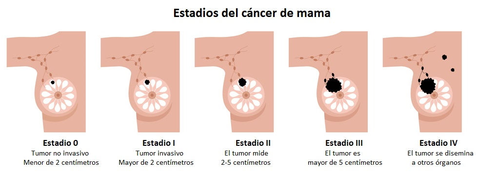 Estadios del cáncer de mama: qué significan y su pronóstico
