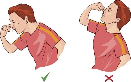 Cómo detener el sangrado nasal: no se debe echar la cabeza hacia atrás
