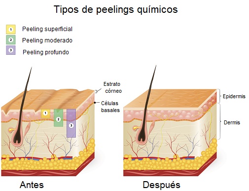 Ilustración sobre los tipos de peelings químicos y su resultado en la piel