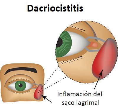 Dacriocistitis o inflamación del saco lagrimal