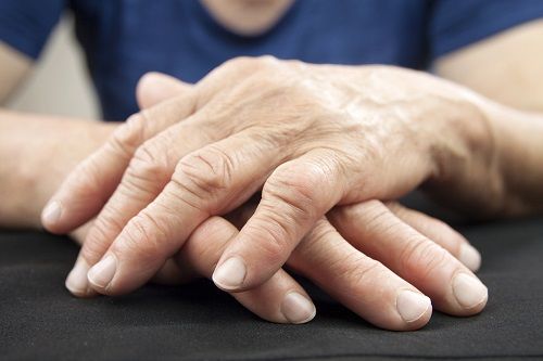 Artrosis de las manos y dedos. Síntomas, Causas, Prevención y Tratamiento
