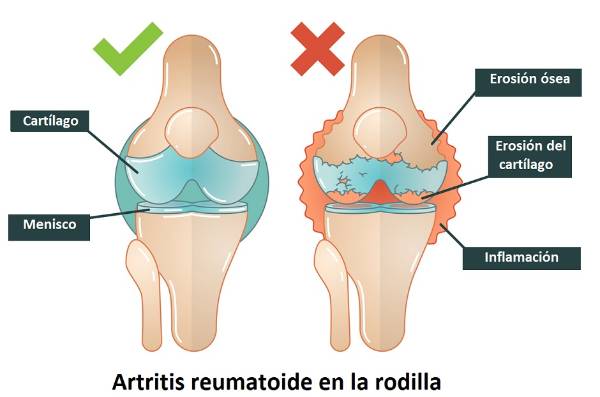 Ilustración de rodilla sana comparada con una rodilla con artritis reumatoide