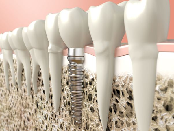 Vista de corte transversal del implante dental